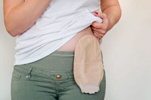 Bolsa de Colostomia Definitiva: Cuidados Essenciais, Benefícios e Informações Cruciais