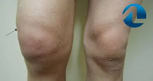 Derrame Articular: Causas, Sintomas e Tratamentos