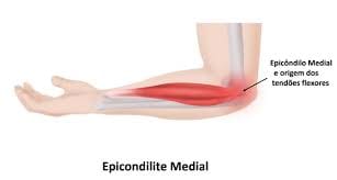 Epicondilite Medial: Causas, Sintomas e Tratamentos