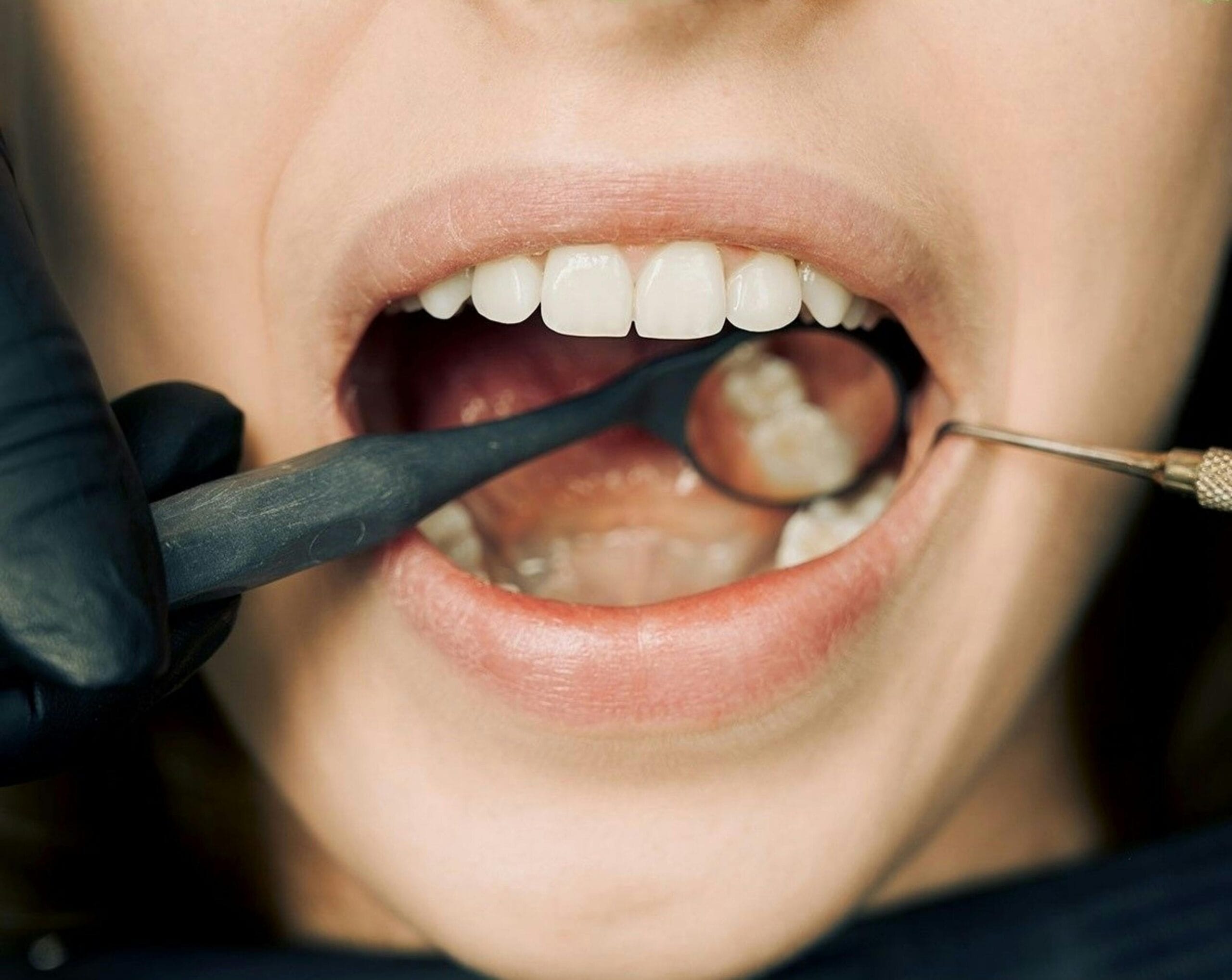 Tártaro nos Dentes: Como Prevenir, Remover e Tratar Eficazmente