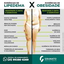 Lipedema: Causas, Sintomas e Tratamentos