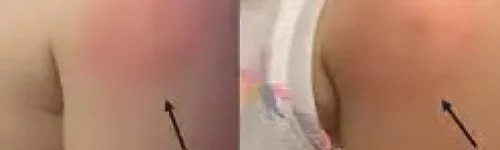 Babesiose: o que é, sintomas, causas e tratamento