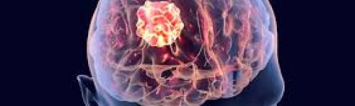 Tumor Cerebral: Causas, Sintomas e Tratamentos