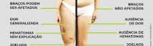 Lipedema: Causas, Sintomas e Tratamentos