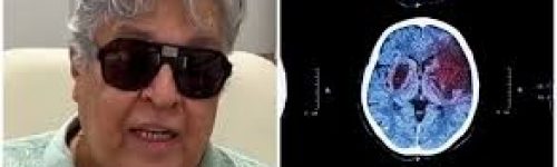 Sidney Magal e o AVC: O Que Aconteceu com o Cantor e Como Prevenir a Doença