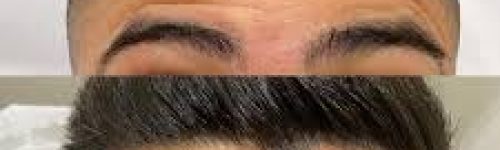 Botox: Para Que Serve, Benefícios, Riscos e Quando é Indicado