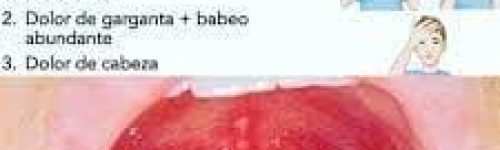 Herpangina na Boca e Garganta: Causas, Sintomas e Tratamentos
