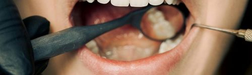 Tártaro nos Dentes: Como Prevenir, Remover e Tratar Eficazmente